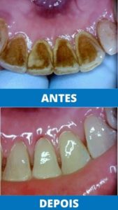 unit-clinica-odontologica-endereco-rua-antonio-ataide-849-ed-rafaela-lj-05-centro-vila-velha-telefone-27-998772036-prevencao-odontologica