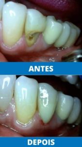 unit-clinica-odontologica-endereco-rua-antonio-ataide-849-ed-rafaela-lj-05-centro-vila-velha-telefone-27-998772036-restauracao-estetica (3)