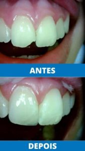 unit-clinica-odontologica-endereco-rua-antonio-ataide-849-ed-rafaela-lj-05-centro-vila-velha-telefone-27-998772036-restauracao-estetica (4)