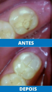 unit-clinica-odontologica-endereco-rua-antonio-ataide-849-ed-rafaela-lj-05-centro-vila-velha-telefone-27-998772036-restauracao-estetica (5)