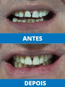 unit-clinica-odontologica-endereco-rua-antonio-ataide-849-ed-rafaela-lj-05-centro-vila-velha-telefone-27-998772036-restauracao-estetica (6)